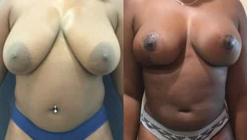 Breast Lift Colombia - Premium Care Plastic Surgery