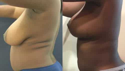 Breast Lift Colombia - Premium Care Plastic Surgery