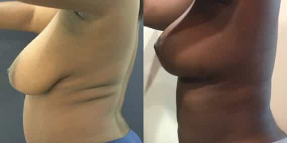 Breast Lift Colombia - Premium Care Plastic Surgery