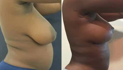 Breast Lift Colombia - Premium Care Plastic Surgery