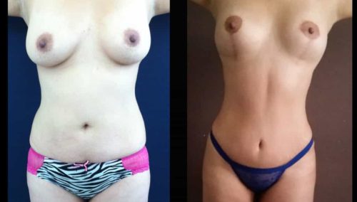 Breast Lift Colombia - Premium Care Plastic Surgery