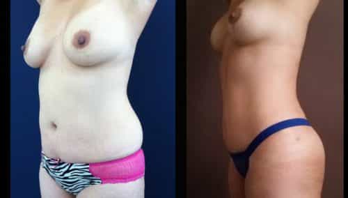 Breast Lift Colombia - Premium Care Plastic Surgery