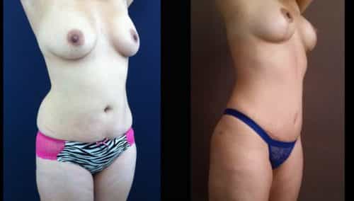 Breast Lift Colombia - Premium Care Plastic Surgery
