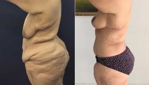 Breast Lift Colombia - Premium Care Plastic Surgery