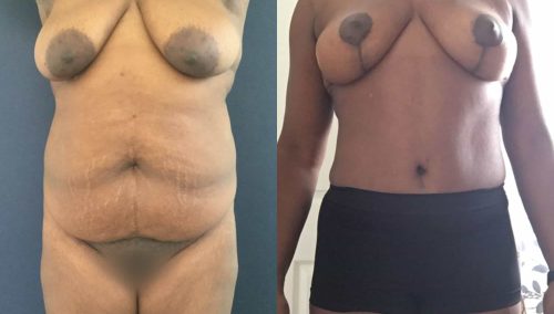 Breast Lift Colombia - Premium Care Plastic Surgery
