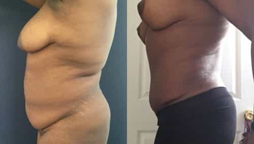 Breast Lift Colombia - Premium Care Plastic Surgery