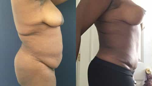 Breast Lift Colombia - Premium Care Plastic Surgery