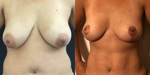 Breast Lift Colombia - Premium Care Plastic Surgery