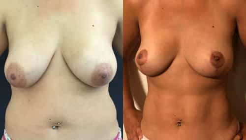 Breast Lift Colombia - Premium Care Plastic Surgery
