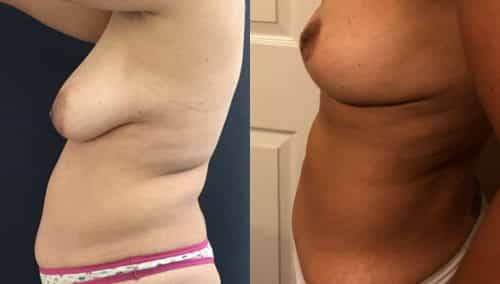 Breast Lift Colombia - Premium Care Plastic Surgery
