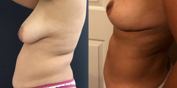 Breast Lift Colombia - Premium Care Plastic Surgery