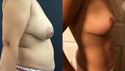 Breast Lift Colombia - Premium Care Plastic Surgery