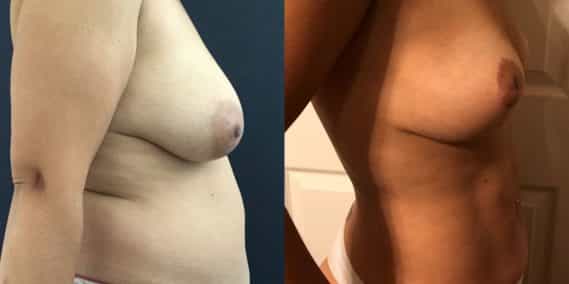 Breast Lift Colombia - Premium Care Plastic Surgery