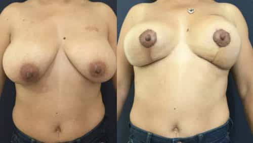 Breast Lift Colombia - Premium Care Plastic Surgery