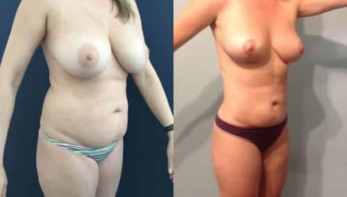 Breast Lift Colombia - Premium Care Plastic Surgery