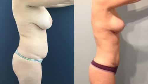 Breast Lift Colombia - Premium Care Plastic Surgery
