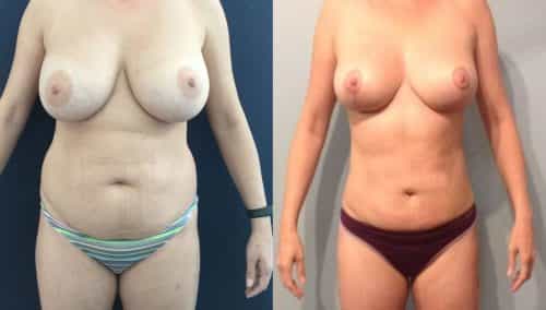 Breast Lift Colombia - Premium Care Plastic Surgery