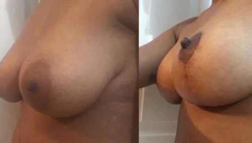 Breast Lift Colombia - Premium Care Plastic Surgery