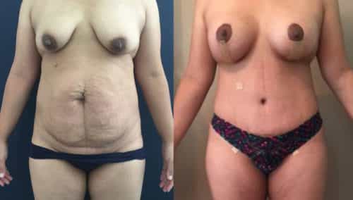 Breast Lift Colombia - Premium Care Plastic Surgery