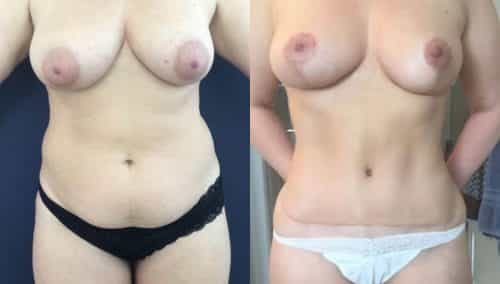 Breast Lift Colombia - Premium Care Plastic Surgery