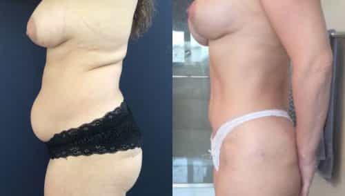 Breast Lift Colombia - Premium Care Plastic Surgery