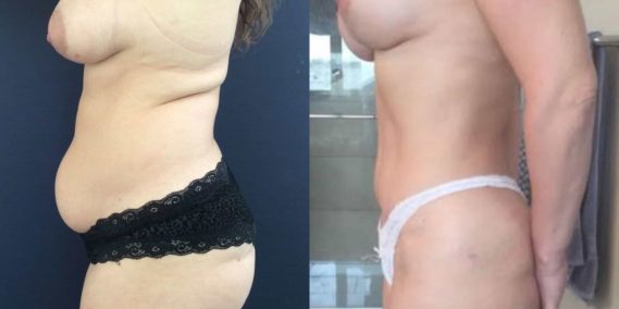 Breast Lift Colombia - Premium Care Plastic Surgery