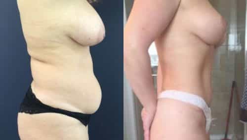 Breast Lift Colombia - Premium Care Plastic Surgery