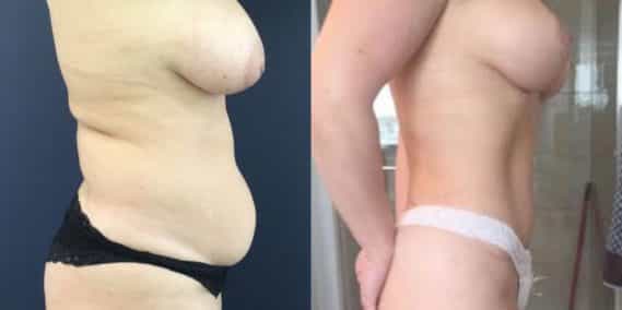 Breast Lift Colombia - Premium Care Plastic Surgery