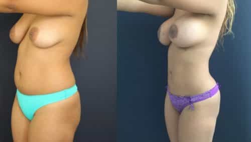 Breast Lift Colombia - Premium Care Plastic Surgery