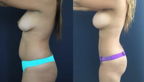 Breast Lift Colombia - Premium Care Plastic Surgery