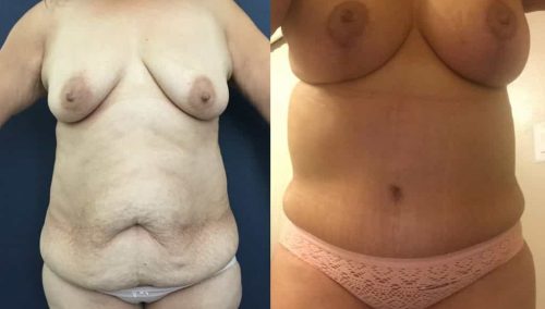 Breast Lift Colombia - Premium Care Plastic Surgery
