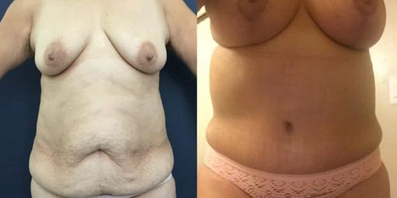 Breast Lift Colombia - Premium Care Plastic Surgery