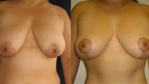 Breast Lift Colombia - Premium Care Plastic Surgery