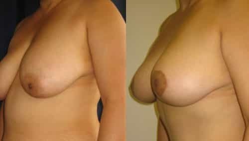 Breast Lift Colombia - Premium Care Plastic Surgery