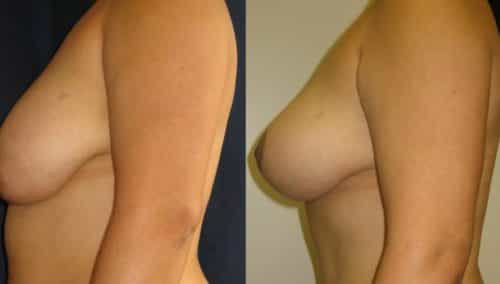 Breast Lift Colombia - Premium Care Plastic Surgery