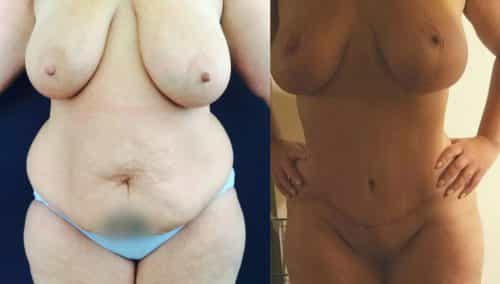 Breast Lift Colombia - Premium Care Plastic Surgery