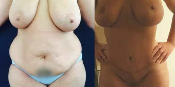 Breast Lift Colombia - Premium Care Plastic Surgery