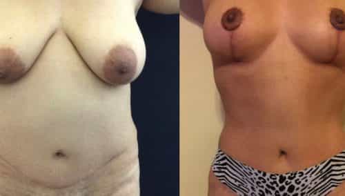Breast Lift Colombia - Premium Care Plastic Surgery