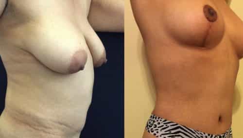Breast Lift Colombia - Premium Care Plastic Surgery