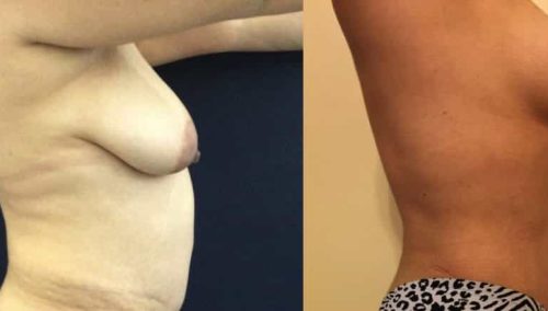Breast Lift Colombia - Premium Care Plastic Surgery