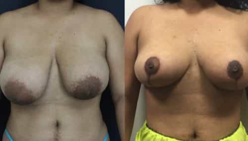Breast Lift Colombia - Premium Care Plastic Surgery