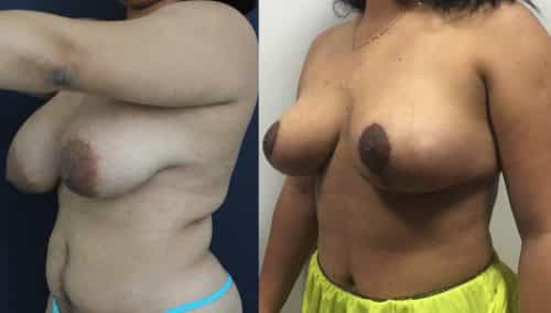 Breast Lift Cartagena Colombia - Premium Care Plastic Surgery