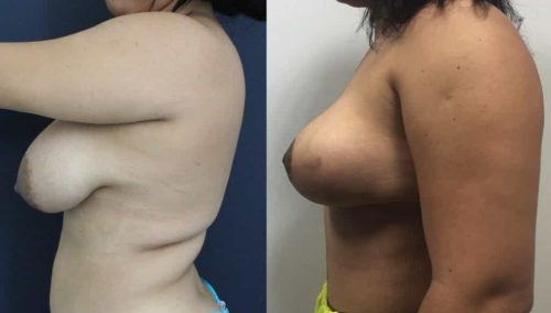 Breast Lift Cartagena Colombia - Premium Care Plastic Surgery