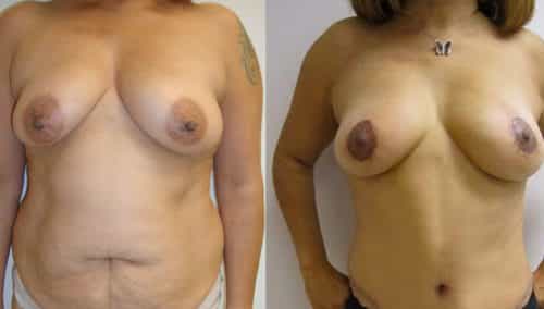 Breast Lift Colombia - Premium Care Plastic Surgery