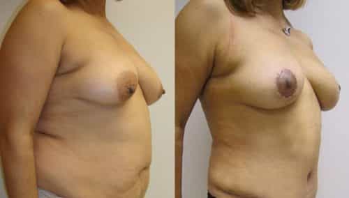 Breast Lift Colombia - Premium Care Plastic Surgery