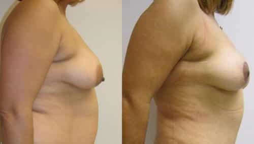 Breast Lift Colombia - Premium Care Plastic Surgery