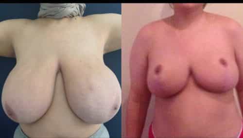 Breast Lift Colombia - Premium Care Plastic Surgery