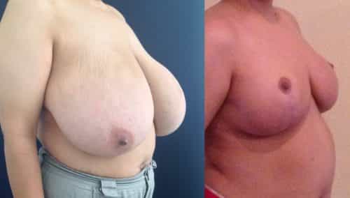 BraBreast Lift Colombia - Premium Care Plastic Surgeryeast Lift Cartagena Colombia - Premium Care Plastic Surgery