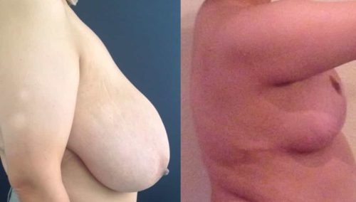 Breast Lift Colombia - Premium Care Plastic Surgery