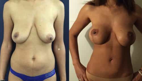 Breast Lift Colombia - Premium Care Plastic Surgery